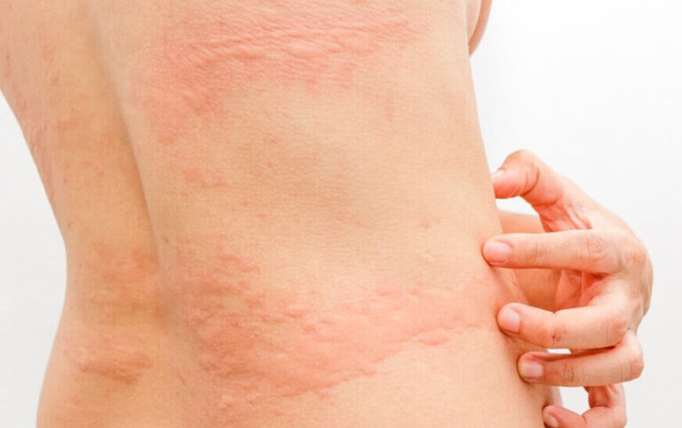 urticaria-ao-frio