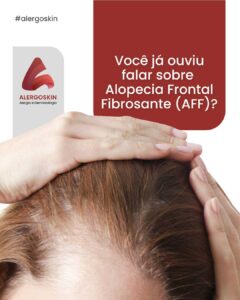 alopecia-frontal-fibrosante