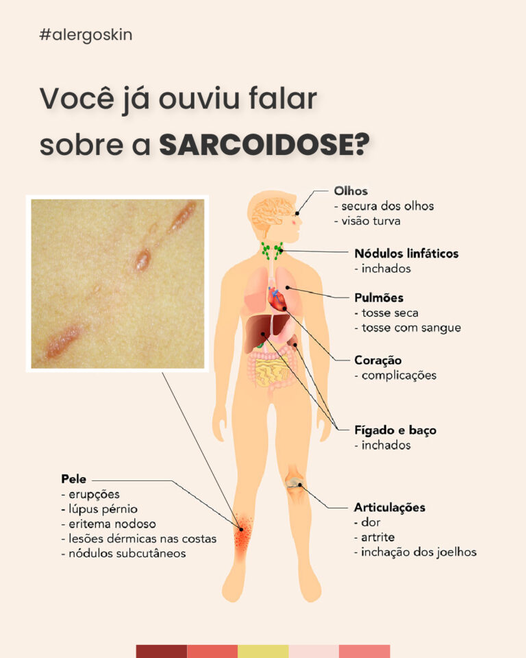 sarcoidose-o-que-e