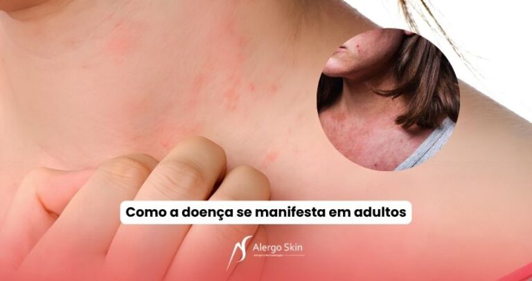 como-a-dermatite-atopica-se-manifesta-em-adultos