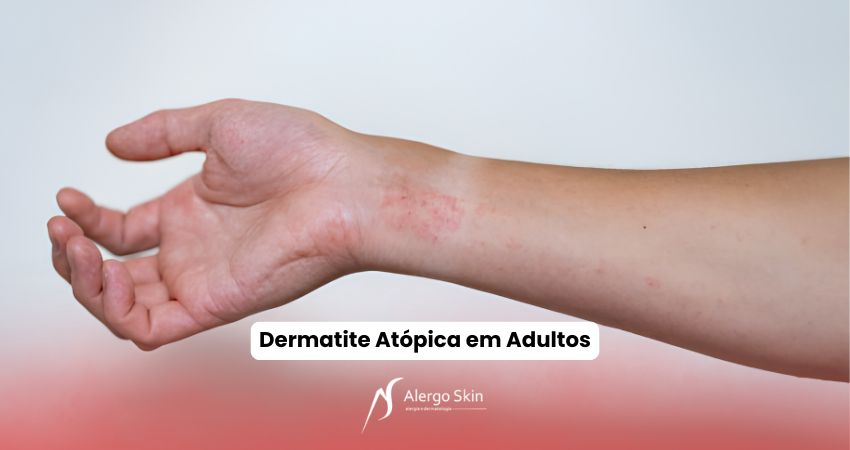 dermatite-atopica-em-adultos