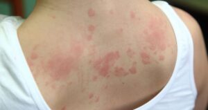 urticaria-ou-dermatite