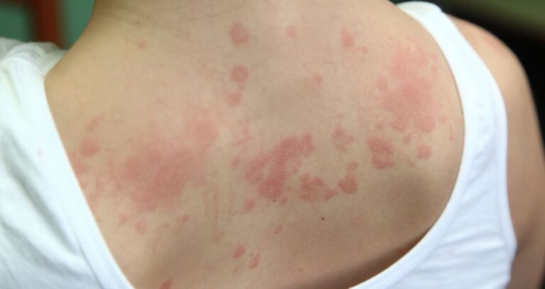 urticaria-ou-dermatite