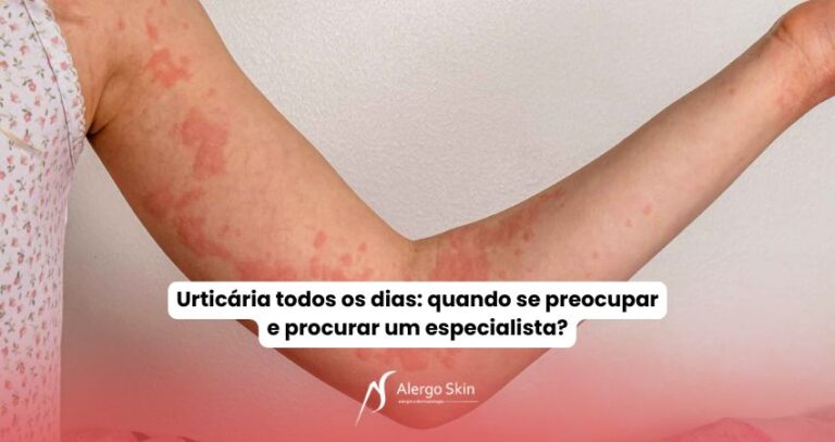 urticaria-quando-procurar-um-especialista