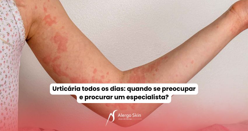 urticaria-quando-procurar-um-especialista